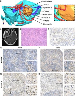 Case Report: Extensive Temporal Bone Invasion in a Giant Vestibular Schwannoma